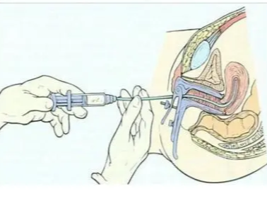 内膜薄如纸，种子难发芽?宫腔灌注让‘贫瘠土壤’逆袭‘沃土’!